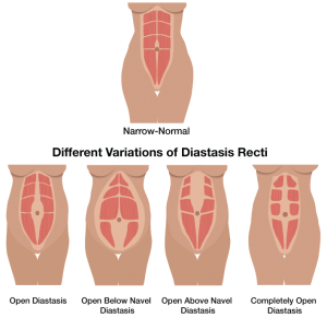 Diastasis Recti (abdominal separation)